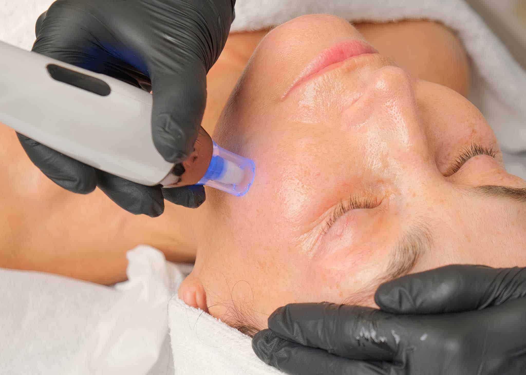 Microneedling med Dermapen som stimulerer kollagenproduksjon for jevnere hudstruktur, redusert aknearr og økt glød, utført av medisinsk fagpersonell i Oslo.