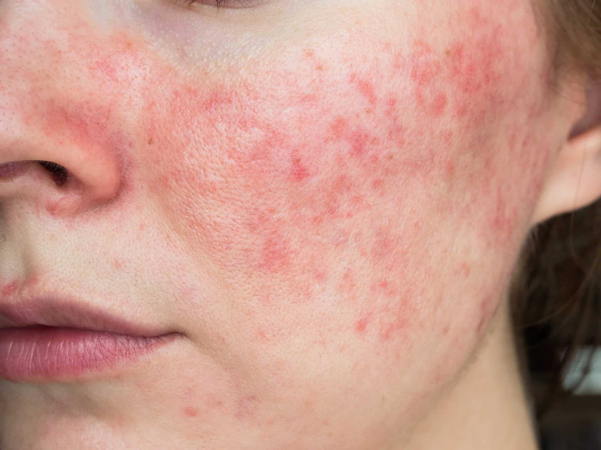 Medisinsk behandling for rosacea som reduserer rødhet, synlige blodkar og hudirritasjon, utført av fagpersonell i Oslo med individuell tilpasning.
