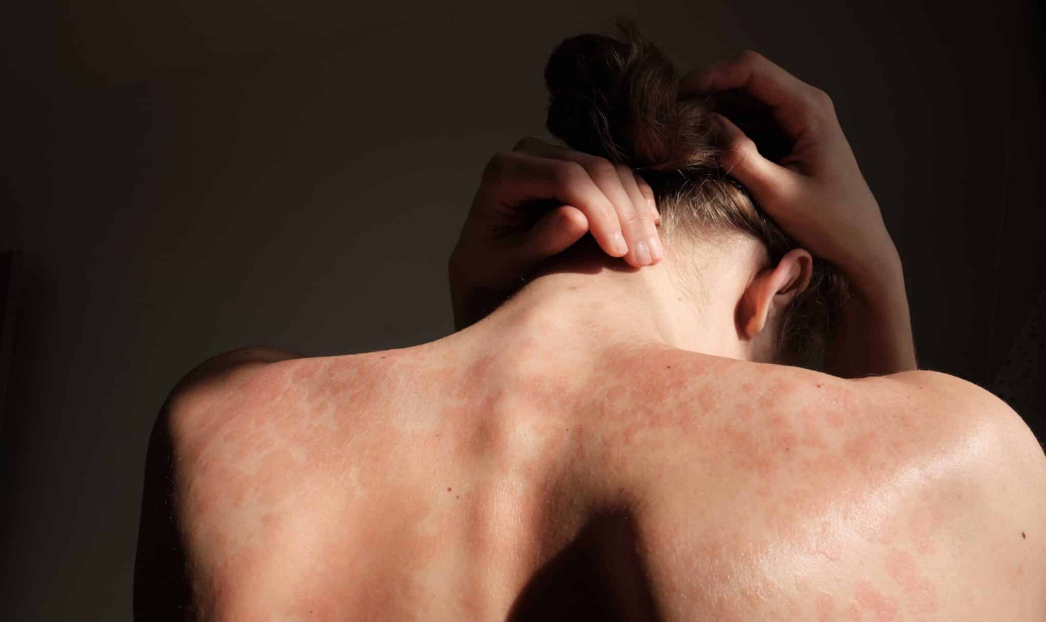 Medisinsk behandling av psoriasis med tilpassede salver, lysbehandling og livsstilsråd, utført av medisinsk fagpersonell i Oslo for symptomkontroll.