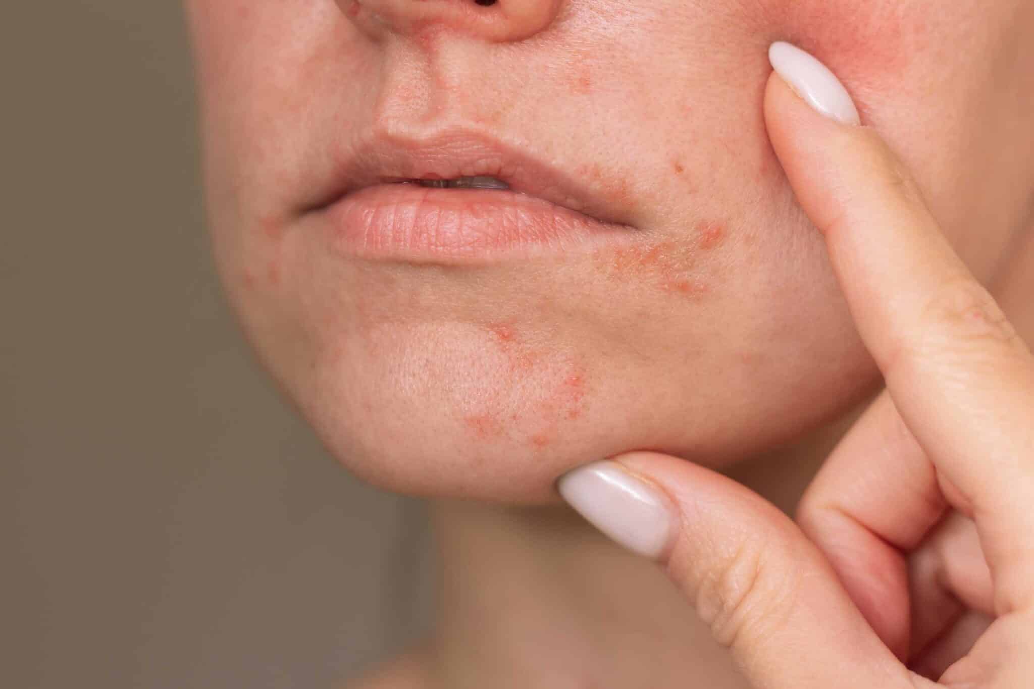 Medisinsk behandling for perioral dermatitt som reduserer rødhet, nupper og hudirritasjon rundt munn, nese og øyne, utført av fagpersonell i Oslo.